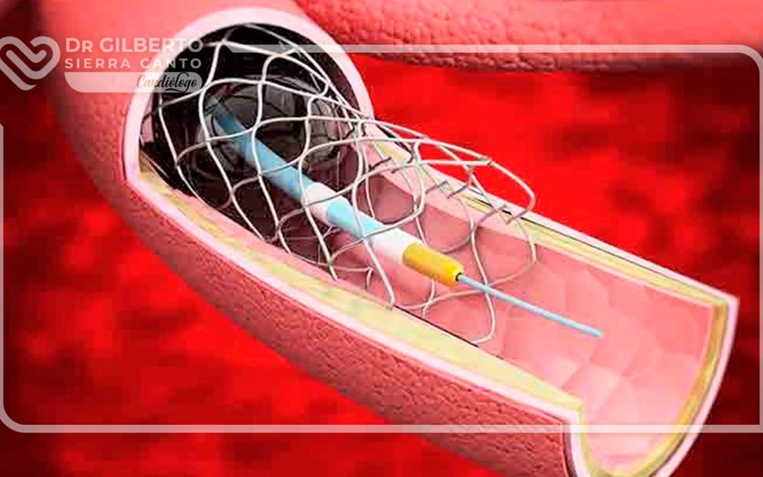 Colocación de stent en aorta